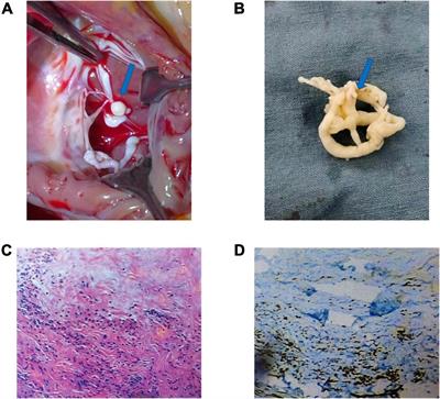 A Rare Case of Cardiac Metastatic Uterine Intravenous Leiomyomatosis